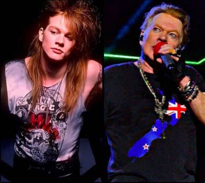 Axl Rose Plastic Surgery A Bad Decision