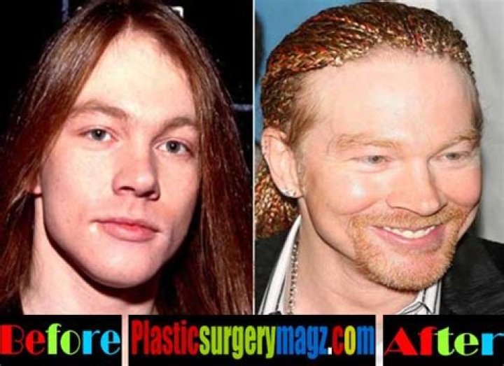 Axl Rose plastic surgery before and after 24 Celebrity plastic